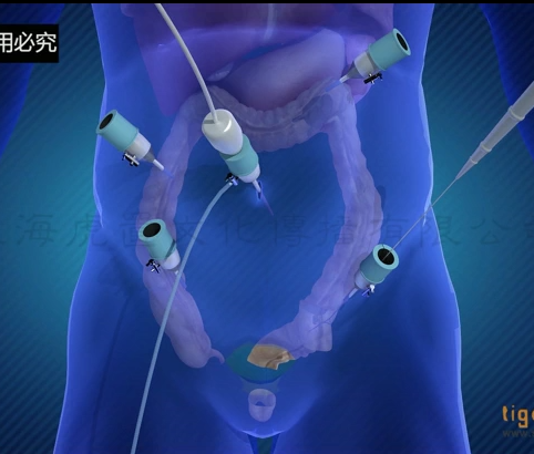 手術治療動畫  醫學動畫 -上海虎置三維動畫制作公司