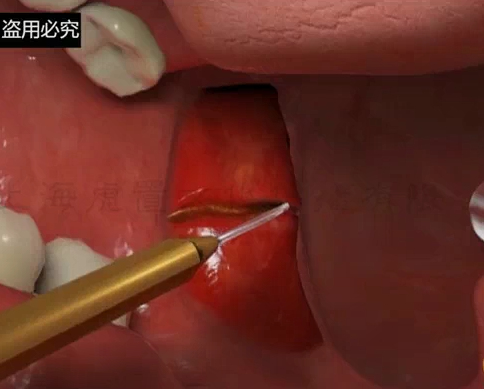 3d醫療演示動畫 手術動畫-上海虎置三維動畫制作公司
